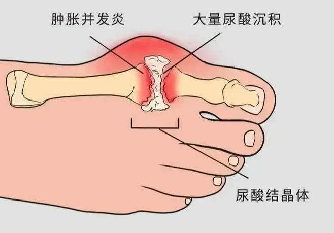尿酸高怎么办